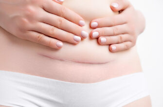 Récupération après une césarienne