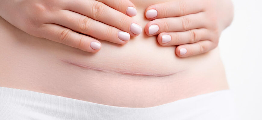 Récupération après une césarienne