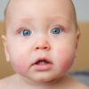Allergies chez les enfants de moins d'un an